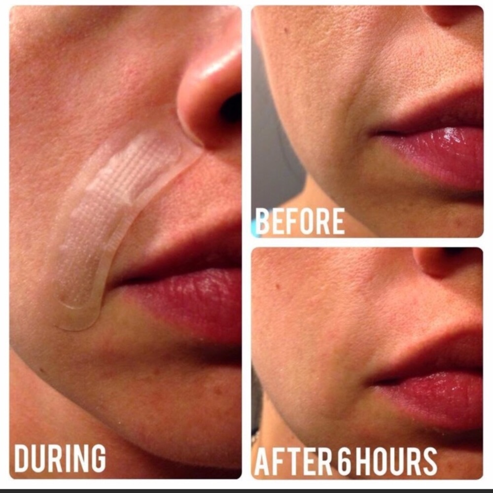R+F Acute Care Redefine Wrinkle Strips - Picture 5 of 7